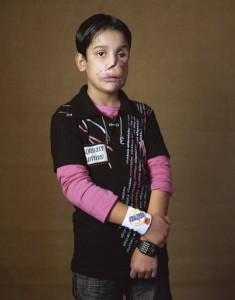 gueules cassées d'Irak