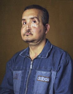 gueules cassées d'Irak